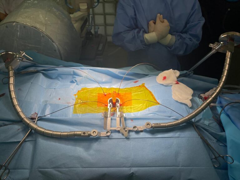 Алматинские нейрохирурги удалили грыжу женщине малоинвазимным методом