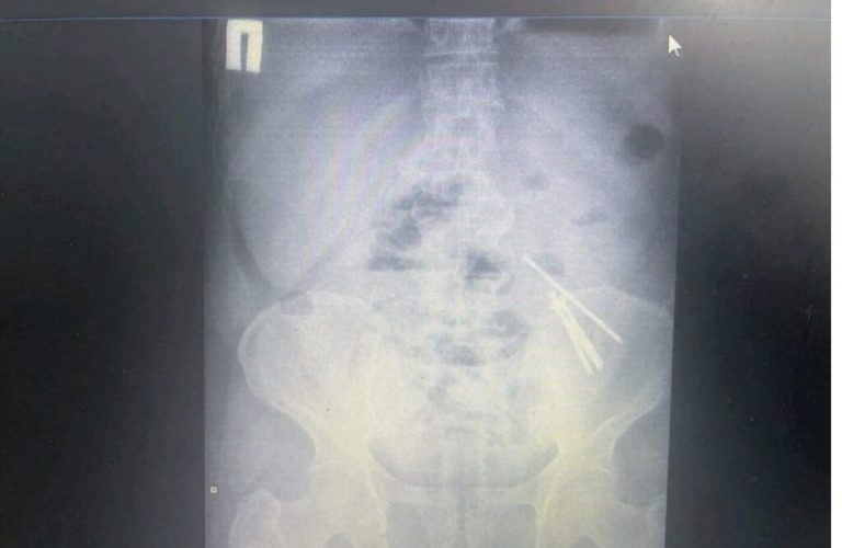 Алматы облысында дәрігерлер 14 шеге жұтқан адамды құтқарды