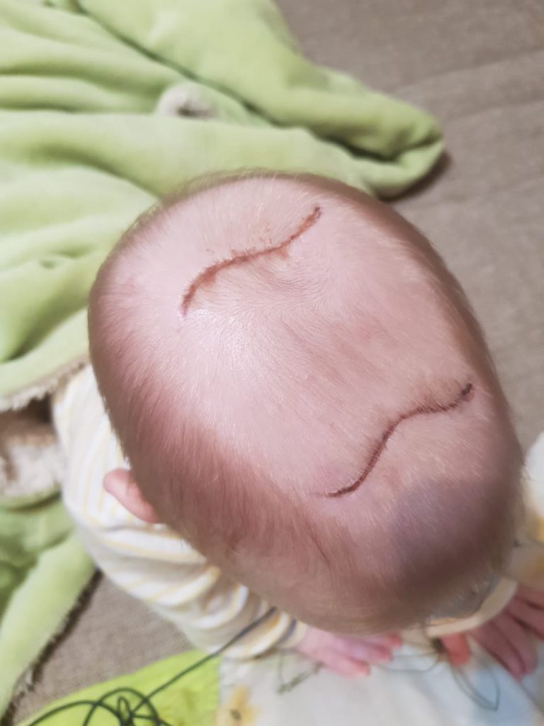 Алматылық дәрігерлер ми мен бас сүйегінің туабітті ақауымен туған балаларға ота жасайды