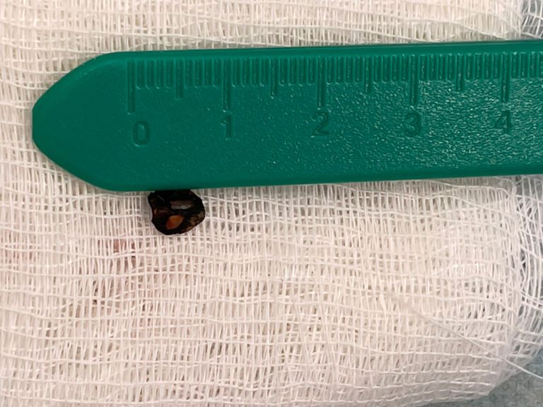 Алматинские офтальмологи спасли зрение мужчине с проникающей травмой глаза