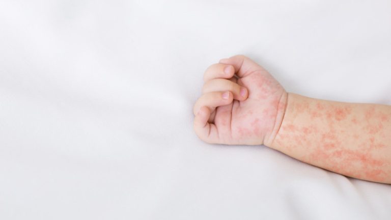 Екпеден бас тарту: Астанада балалар арасында қызылша ауруы тіркеле бастады