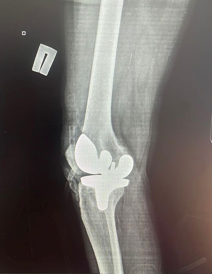 Врачи Карасайской районной больницы впервые провели уникальную операцию на коленный сустав