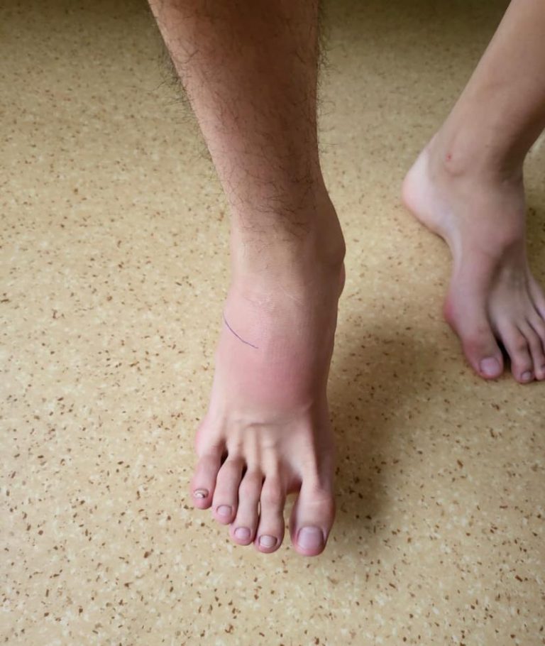 Впервые в Алматы проведена сложнейшая операция по устранению эквинусной деформации стопы («конская стопа») 16-летнему подростку