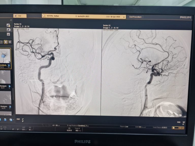 Алматылық нейрохирургтер инсульт соққан пациентті сал болып қалудан сақтап қалды