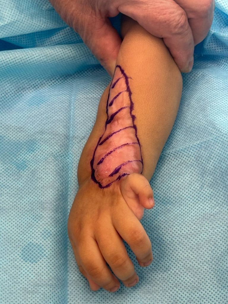 Күрделі патологиясы бар 16 қазақстандық балаға Санкт-Петербург пен Алматының жетекші ортопед-травматологтары операция жасады